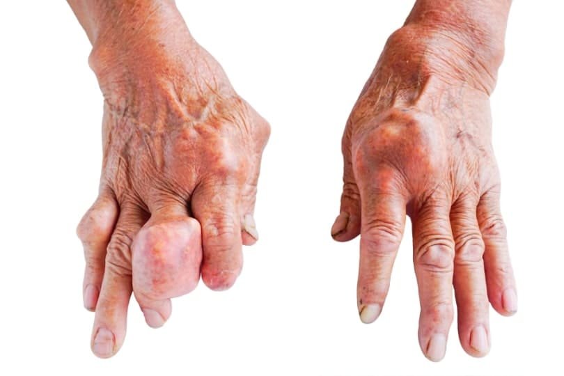 Gout